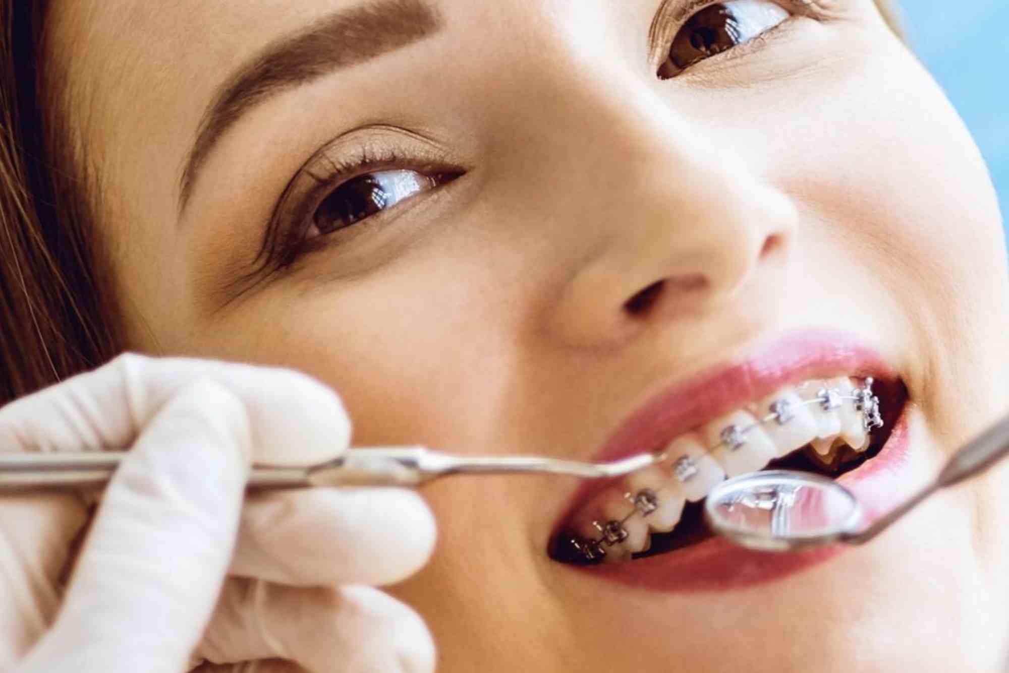 Does Dental Insurance Cover Braces in the UAE?