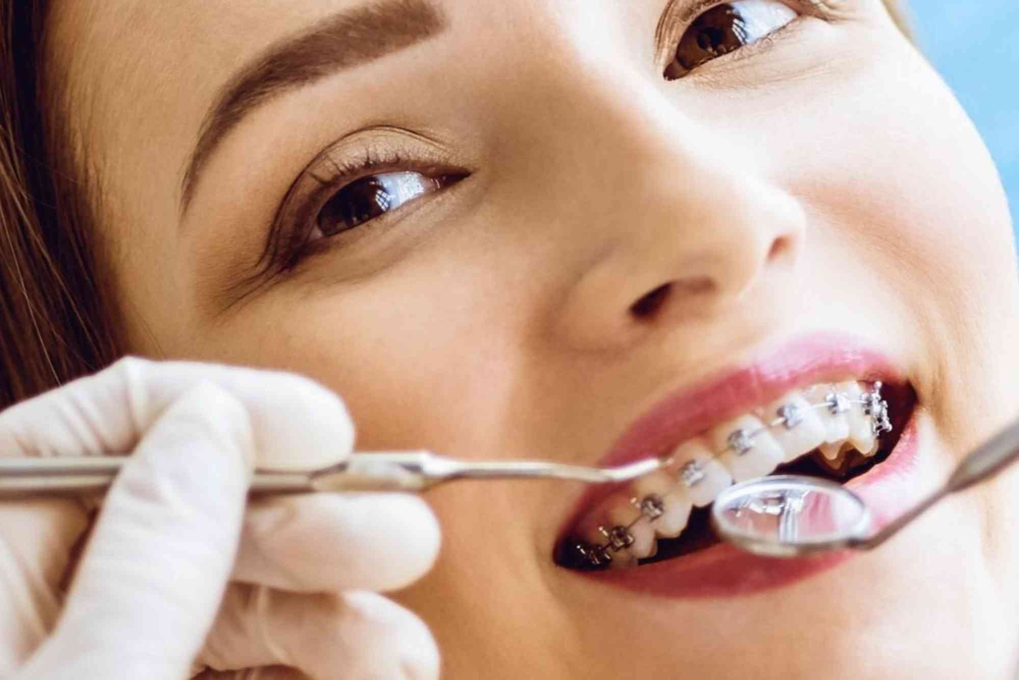 Will Dental Insurance Cover Braces in the UAE