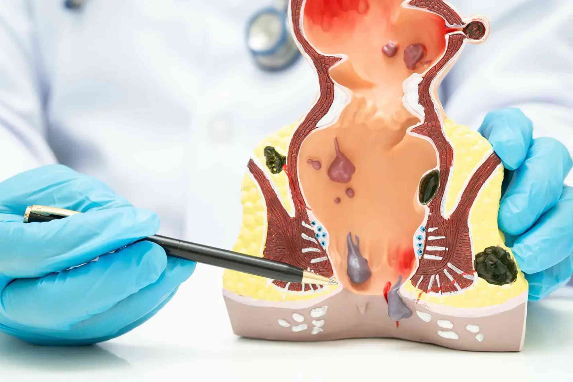 Does Insurance Cover Hemorrhoid Surgery in the UAE